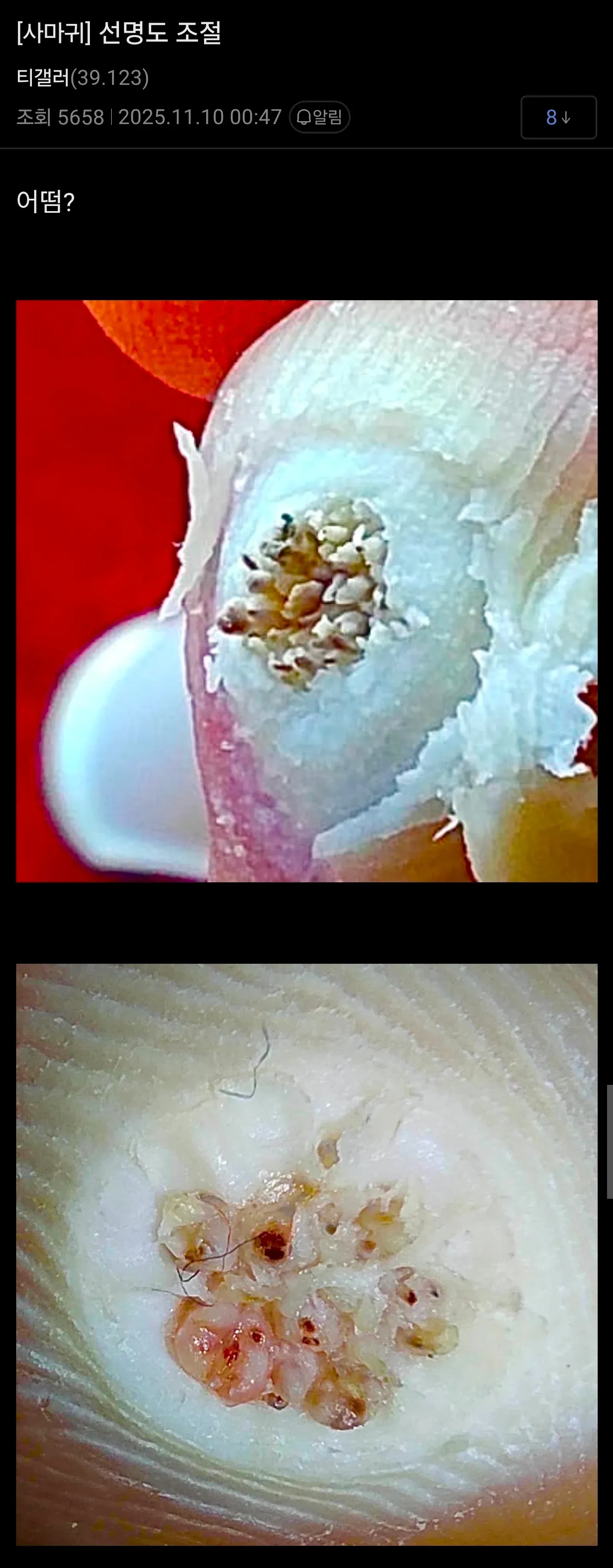 사마귀 선명도 조절 전후 비교 이미지, 조회수 5658