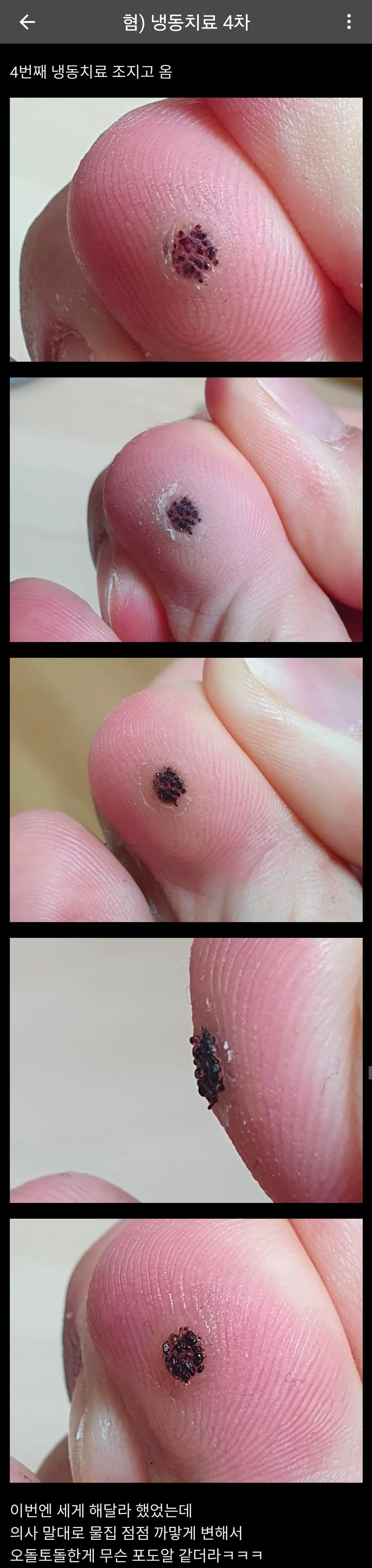 티눈 냉동치료 4차 후기 게시글 캡처