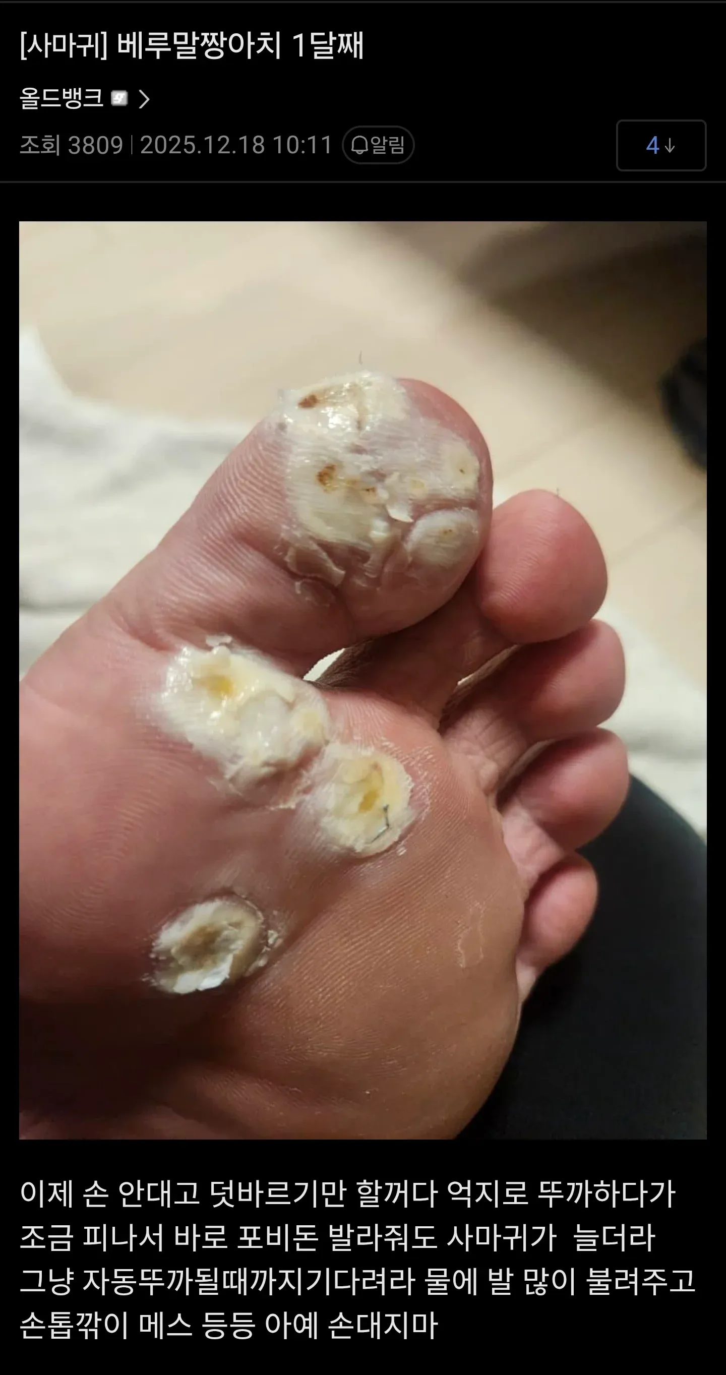 베루말 사마귀 치료 한 달 후기, 억지로 뜯지 말고 자연탈락 대기 권장 글