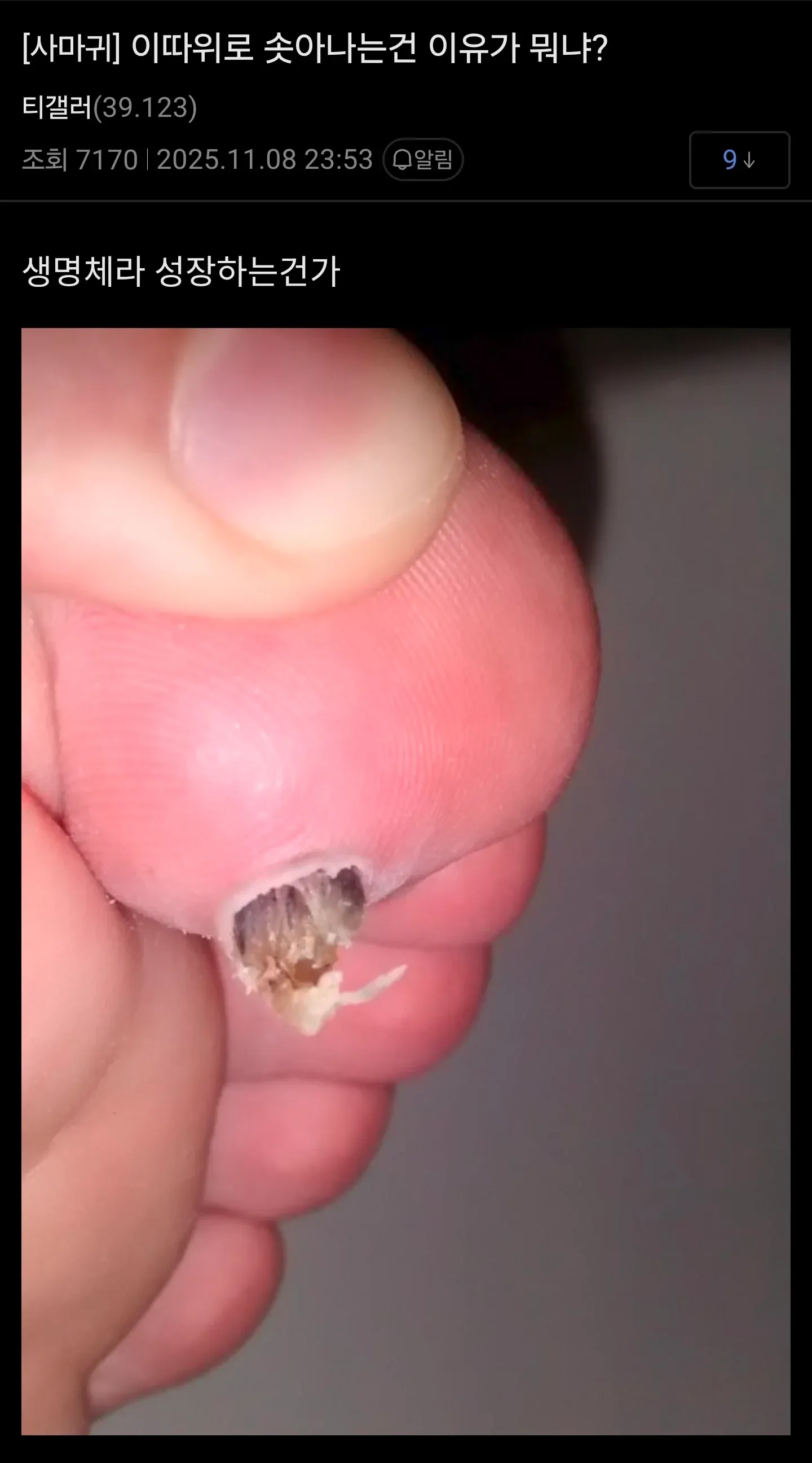 티눈이 자라는 모습에 대한 질문 글 캡처