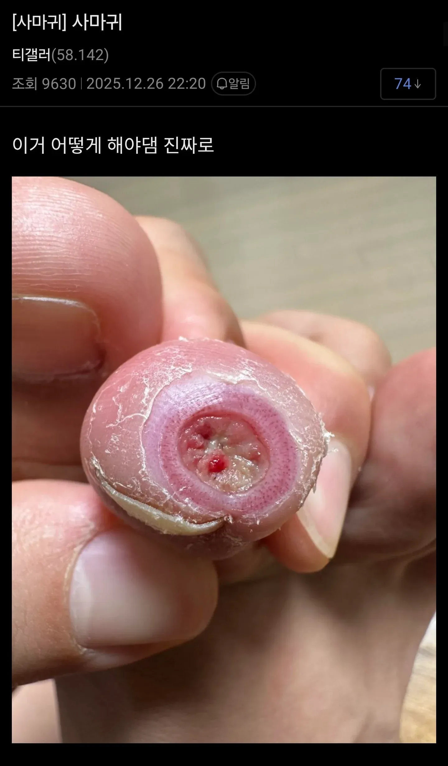 사마귀 제거 방법을 묻는 커뮤니티 질문 게시글 캡처