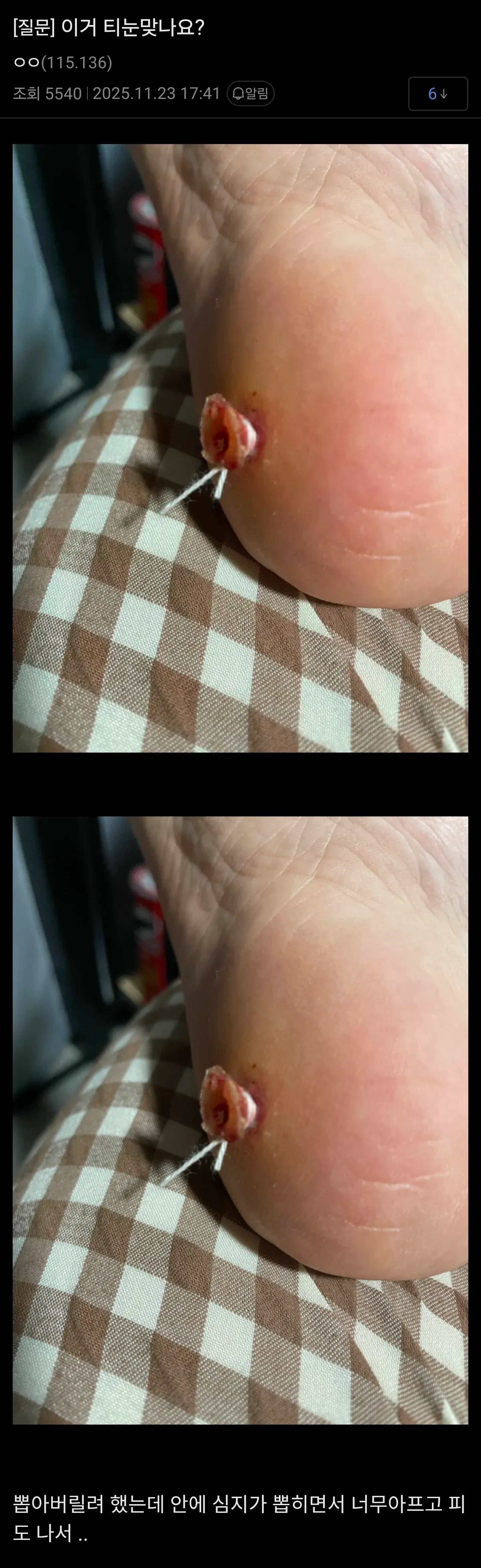 티눈으로 의심되는 발바닥 피부 사진, 심지가 박힌 상태