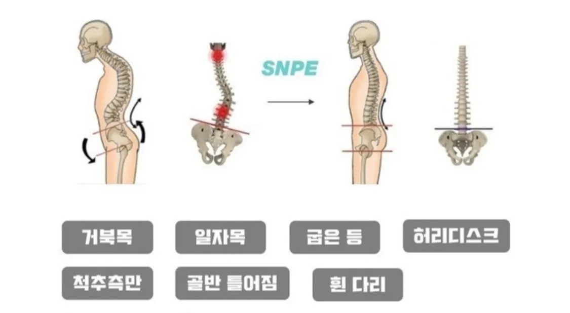 SNPE 거북목, 일자목, 굽은등, 허리디스크, 척추측만, 골반교정, 휜다리 치료 안내 이미지
