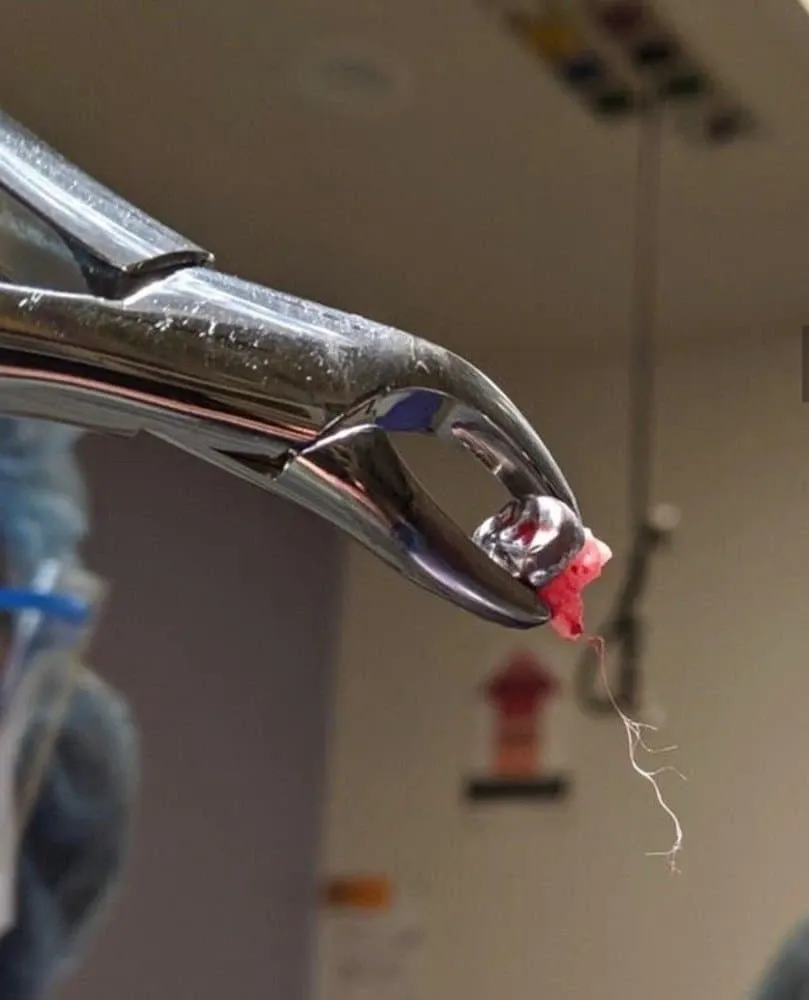 신경치료 중 치아 내부 신경 구조를 보여주는 치과 의료 이미지