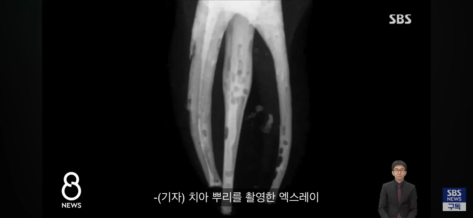 치아 뿌리가 보이는 치과 엑스레이 사진
