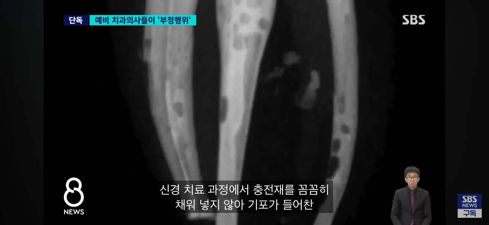 신경 치료 충전재 기포 발생 비교 엑스레이 이미지