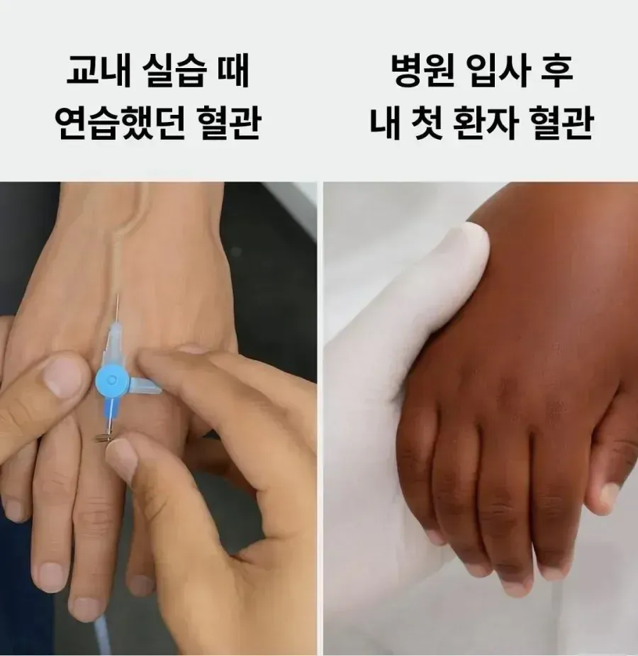 간호사의 학교 실습용 팔 모형 혈관과 실제 환자의 가느다란 혈관 비교 사진