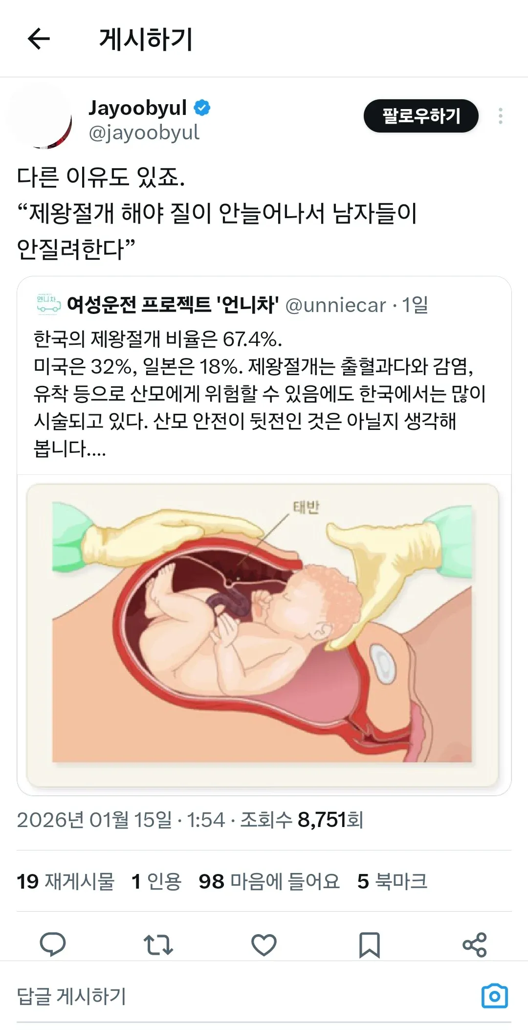 한국의 높은 제왕절개 비율(67.4%)과 산모 안전 문제를 지적하는 SNS 게시물 캡처