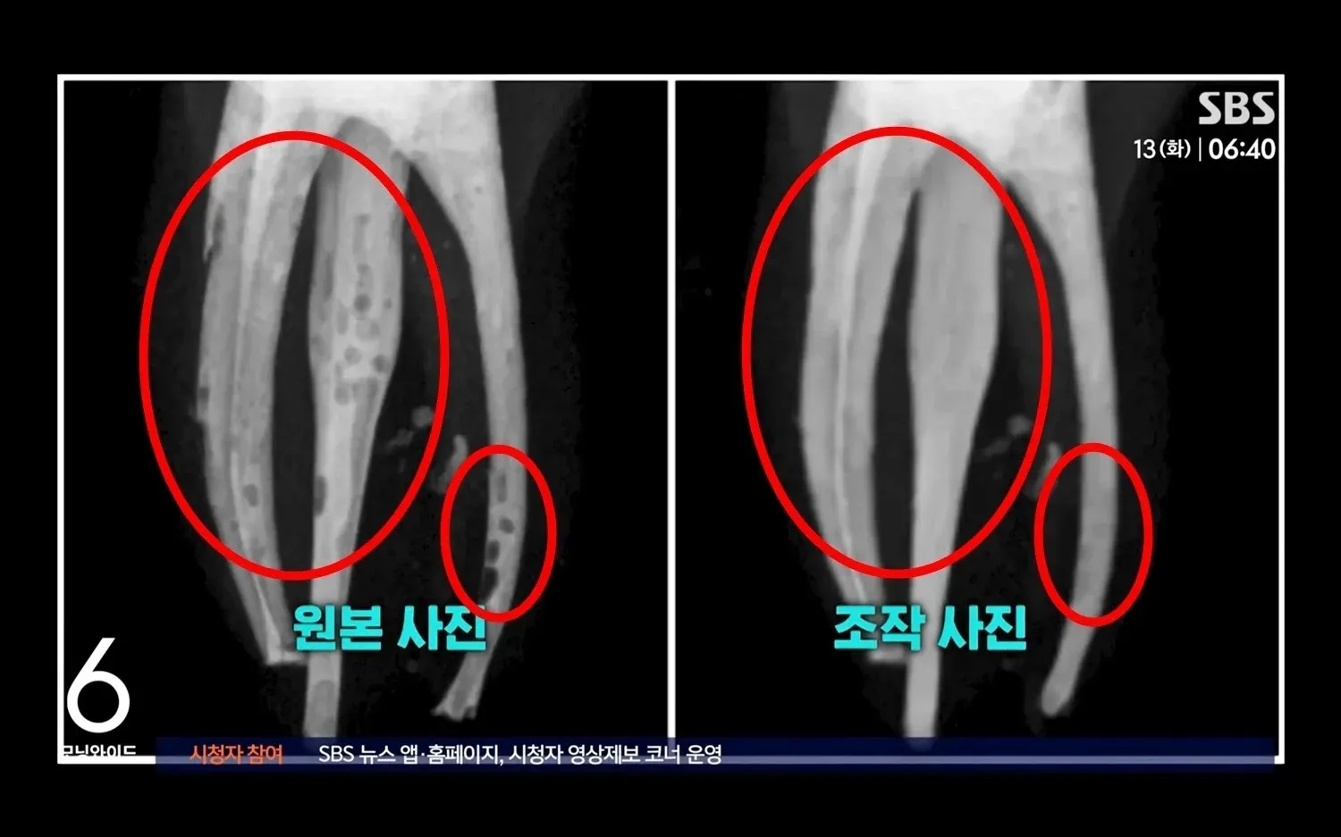 치과 신경치료 전후 비교 사진의 원본과 포토샵 조작본