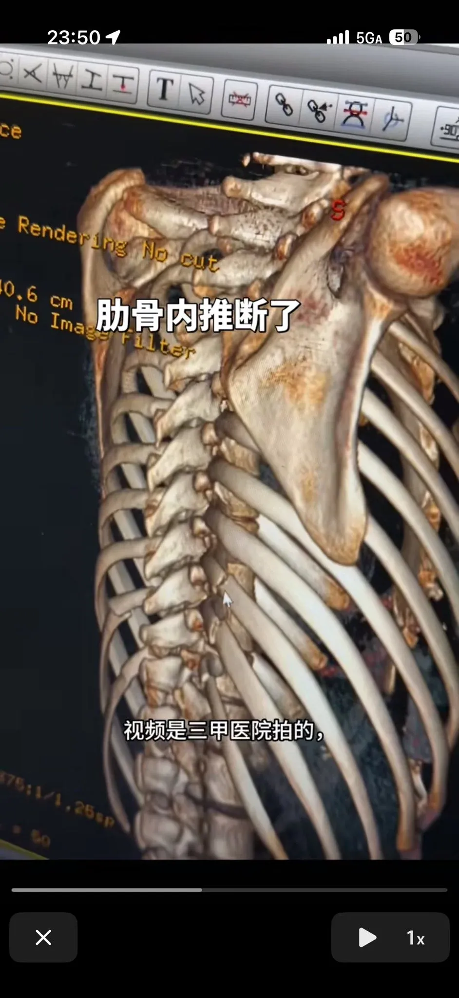 중국어 자막이 표시된 갈비뼈 성형 수술 영상, 삼급 병원에서 촬영