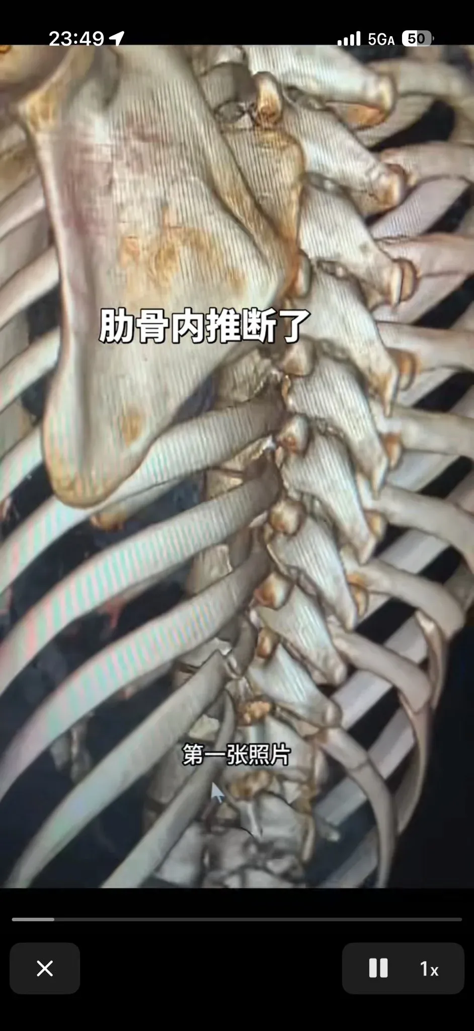 인어허리 성형 전후 비교 사진, 갈비뼈 안쪽으로 밀어넣는 시술 결과