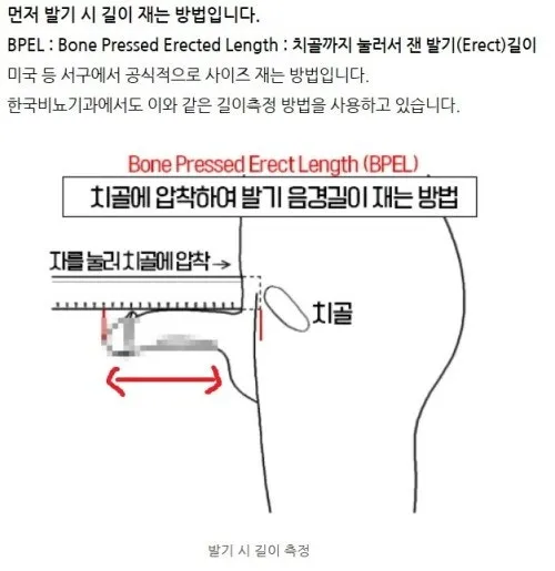 BPEL 방식으로 치골 압착하여 발기 음경 길이를 측정하는 방법 설명 도해