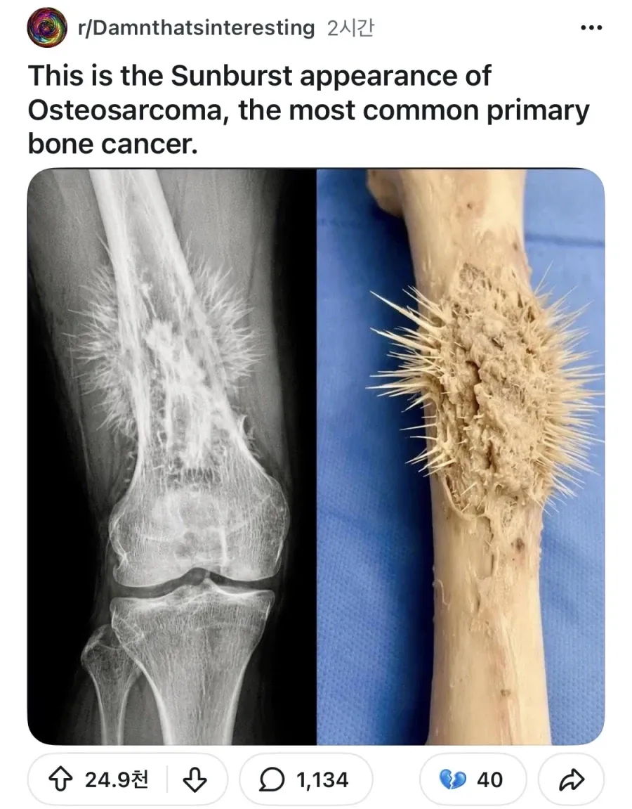 골육종의 햇살 모양 방사형 골막 반응 X선 영상