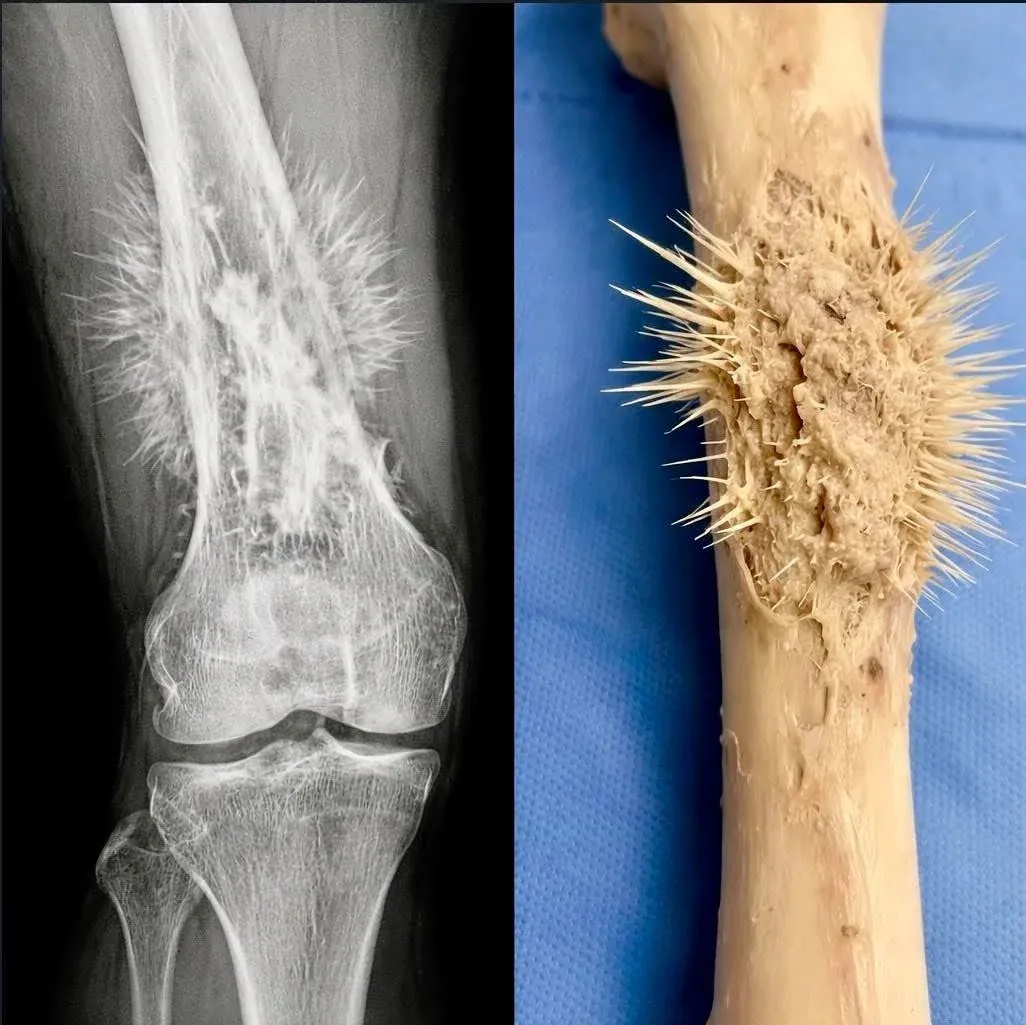 골육종(뼈 암) 의료 교육 자료 다이어그램