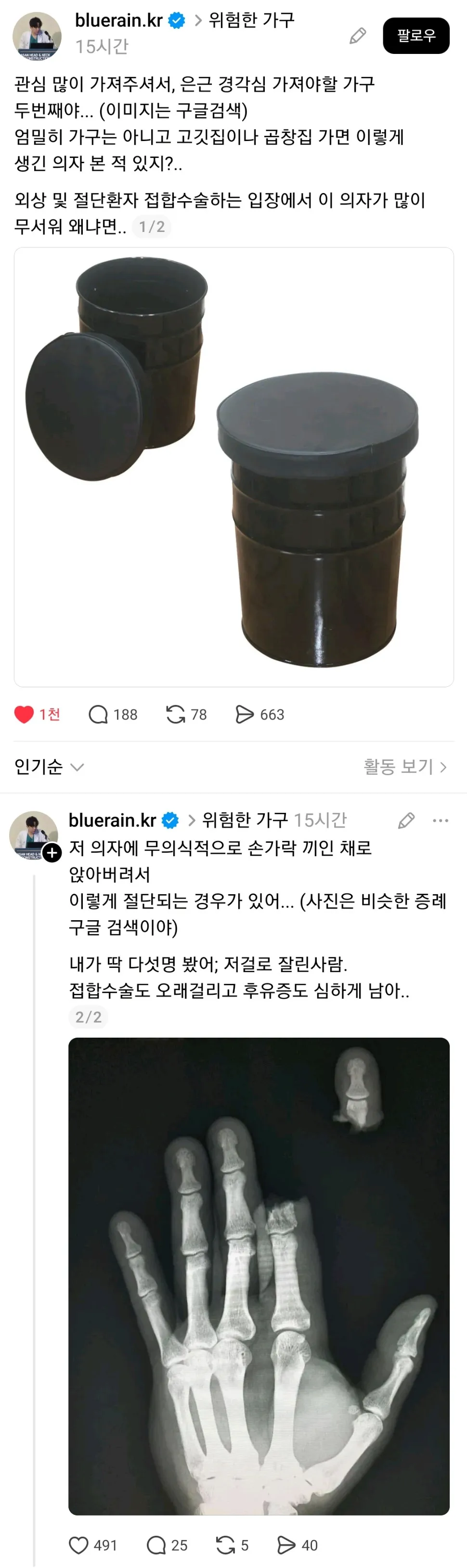 곱창집 의자로 인한 손가락 절단 위험을 보여주는 의료 사례 이미지
