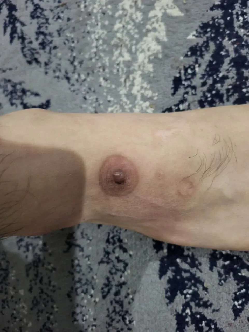 화상흉터가 젖꼭지처럼 보이는 피부 손상 이미지