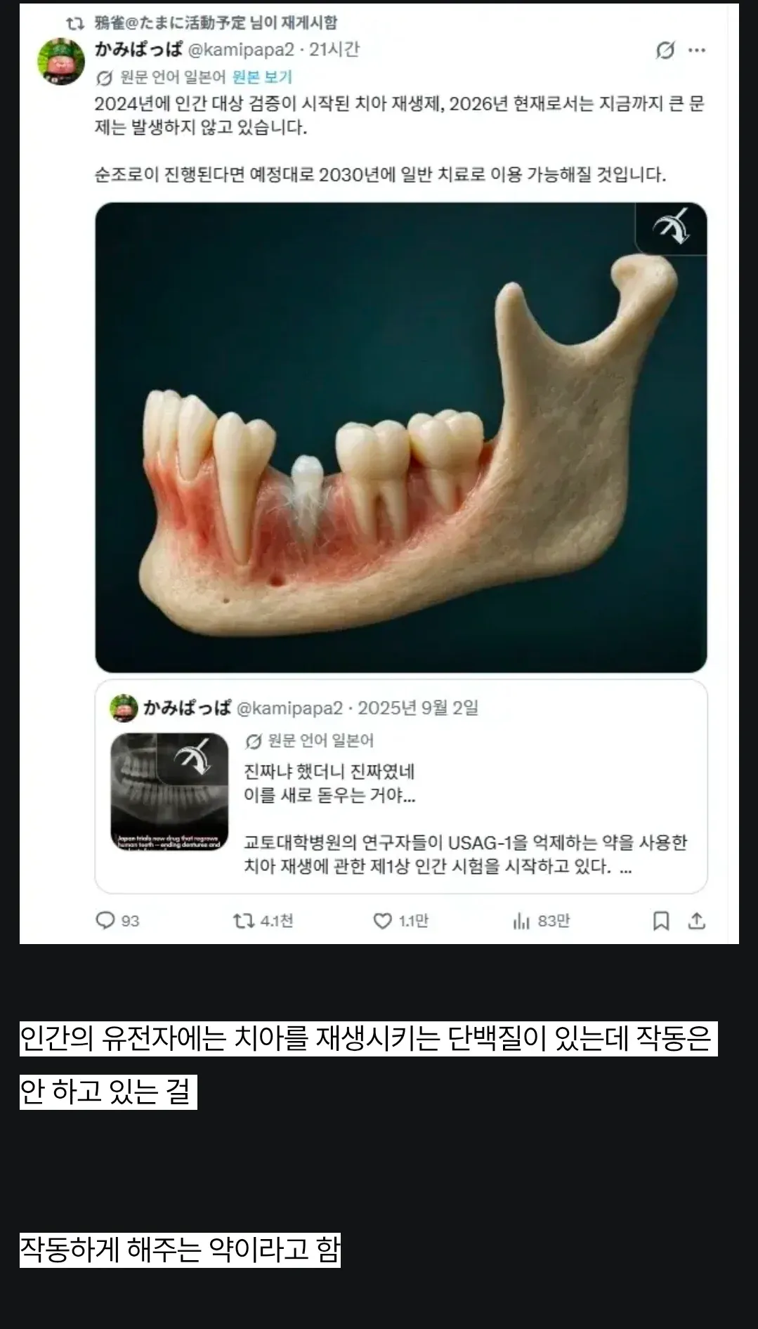 치아 재생 약물 1상 인간 시험 진행 중, 2030년 상용화 예정