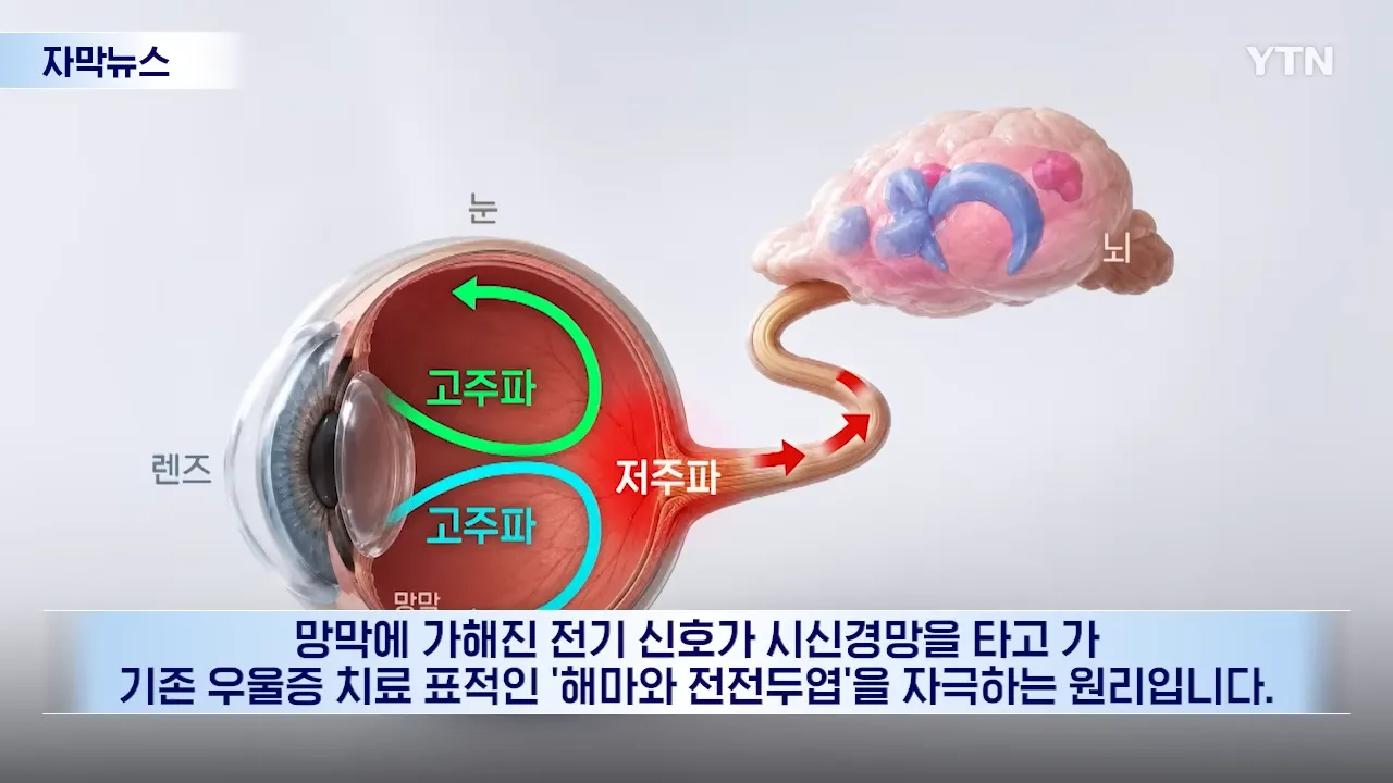 망막 신호로 뇌의 해마와 전전두엽을 자극하는 우울증 치료 콘택트 렌즈 원리