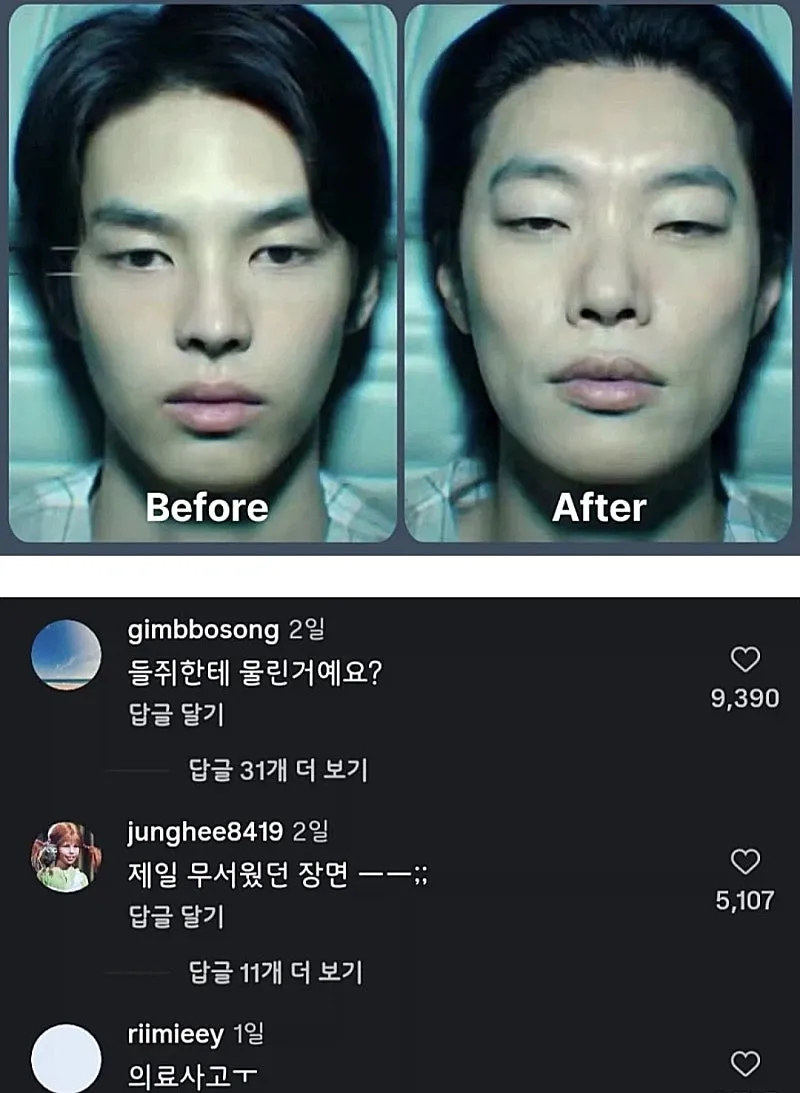 성형 전후를 비교한 사진으로, 수술 전과 후의 얼굴 변화를 나란히 보여준다.