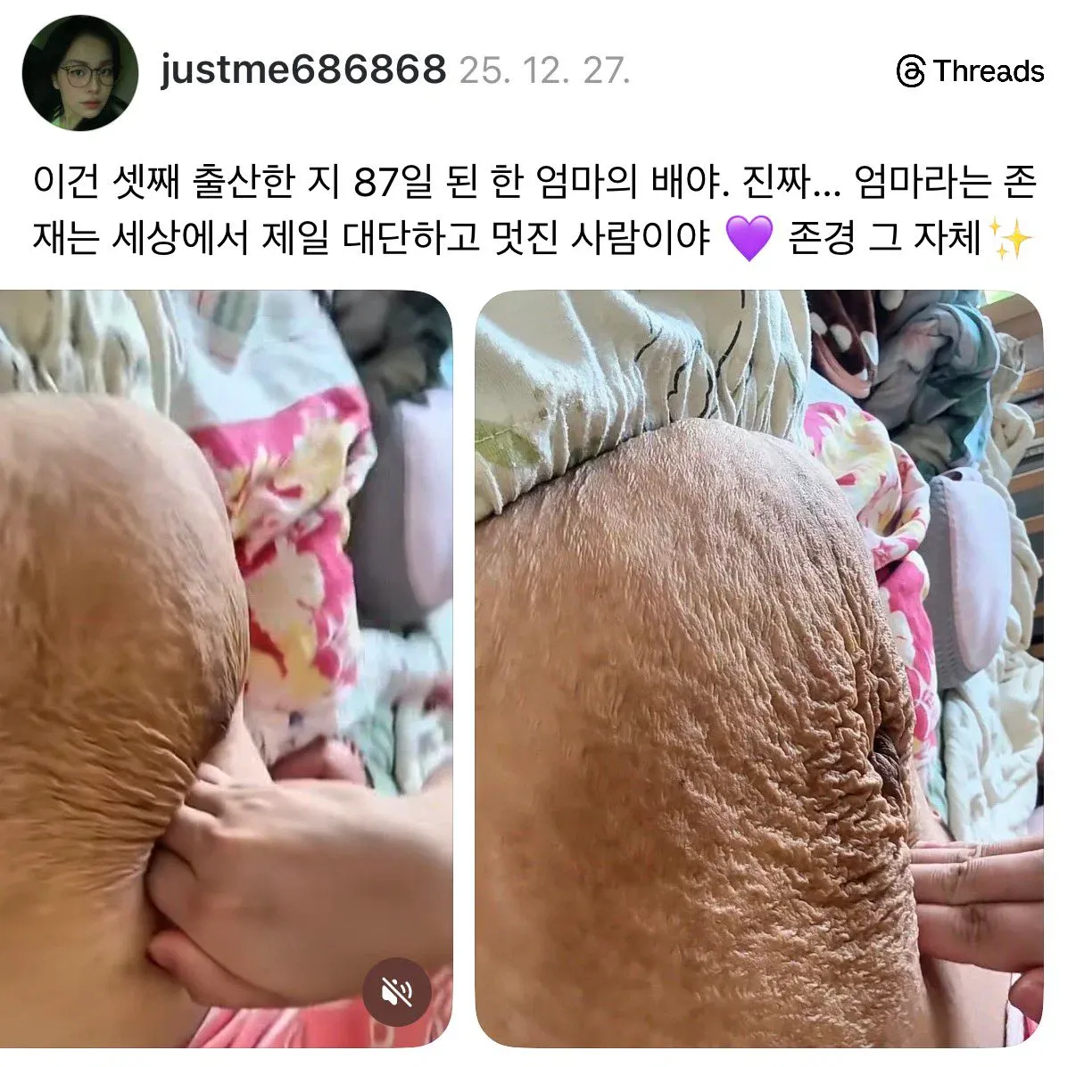 셋째 아이를 출산한 지 87일 된 어머니의 배를 촬영한 사진.