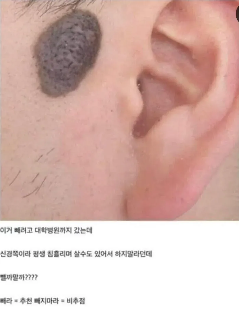 얼굴의 점 제거를 고민하는 디시인