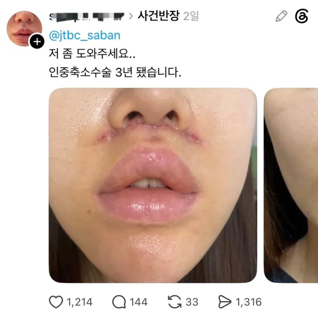 인중축소수술 3년 후 모습을 보여주는 얼굴 사진