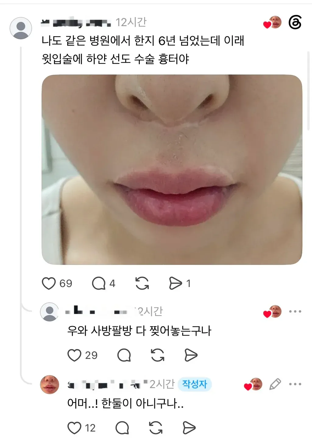 인중축소 수술 흉터를 호소하는 스레드 게시물과 댓글 화면