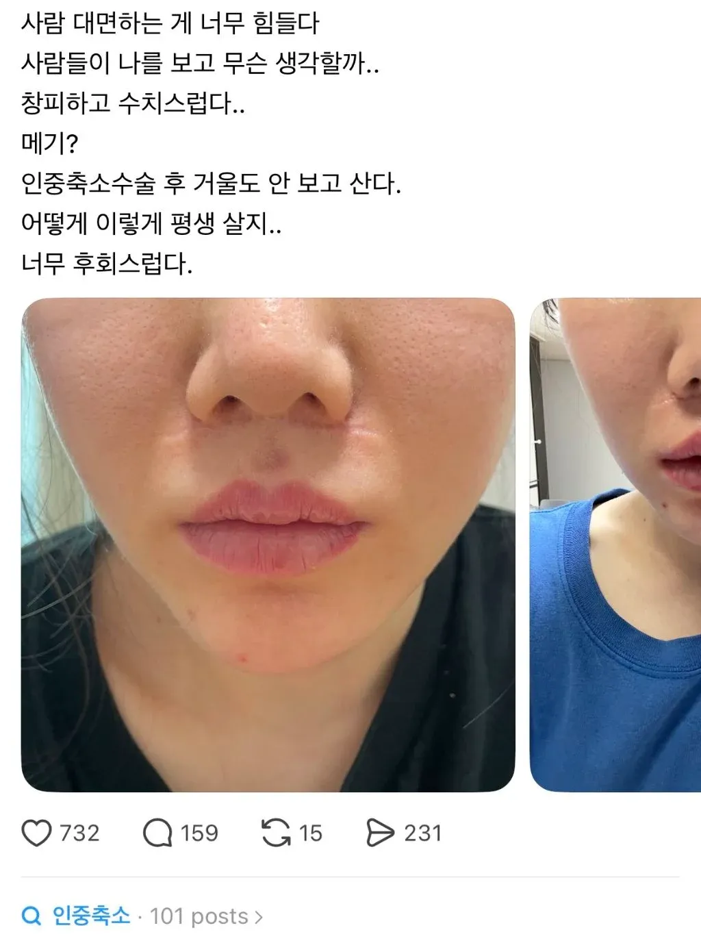인중축소수술 후 외모에 대한 후회를 토로한 온라인 게시물