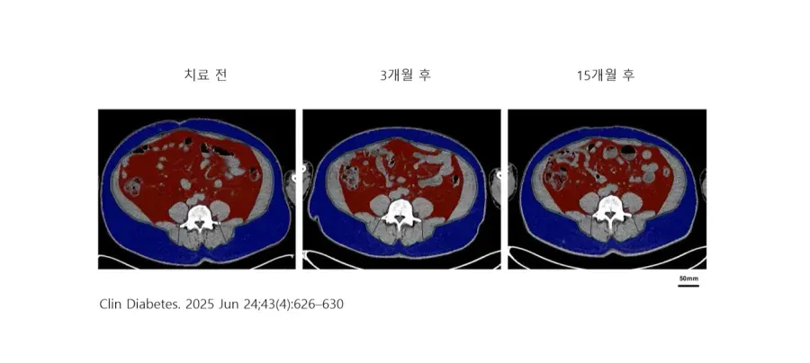 마운자로 치료 전·3개월 후·15개월 후 체중 변화 비교